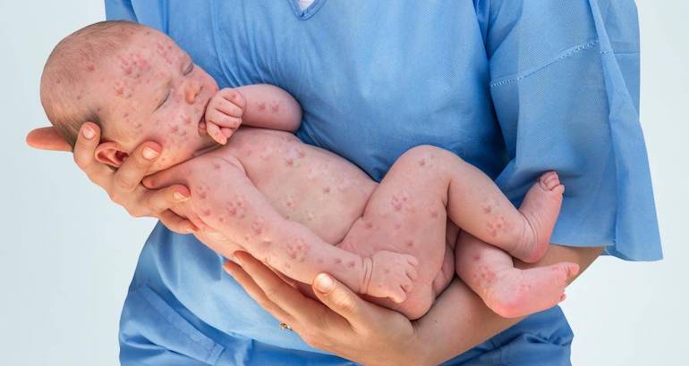 Serbie : sur fond de campagne anti-vaccin, la rougeole se remet à tuer